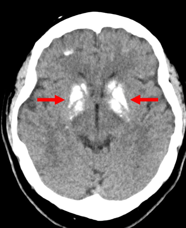 Fahr's Syndrome Brain Scan